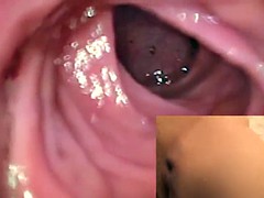 endo anal